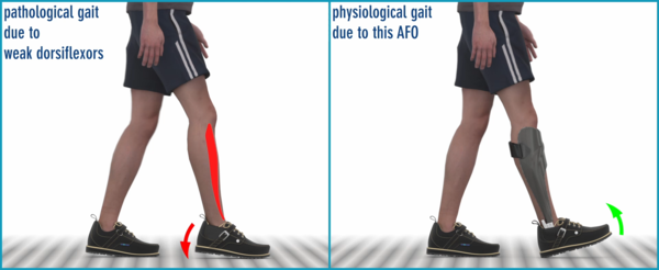 Excerpt from the video describing the action of the muscles that lift the foot to allow a free swing through without stumbling. The video also describes the compensatory effect, i.e. the effect on the gait of the foot drop with the compensatory mechanisms of hip elevation and circumduction and the risk of stumbling. The orthosis AFO with NEURO CLASSIC SPRING leads to a natural gait