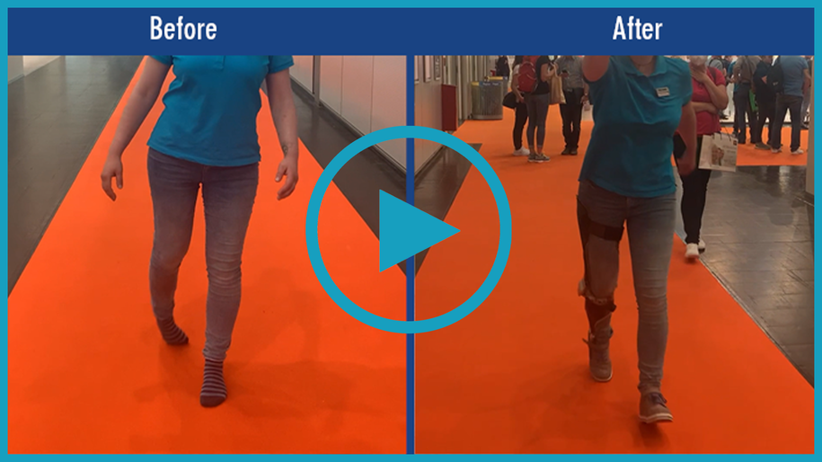Patient video of a patient with monoplegia. Before-and-after comparison of gait without devices and with a custom-made KAFO orthosis with NEURO SWING 2 system ankle joint, providing significantly greater stability when walking. KAFO enables safe walking.