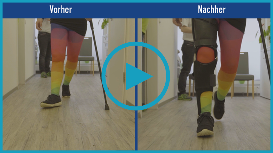 Patientenvideo Video einer Patientin mit Multipler Sklerose MS. Vorher-nachher-Vergleich des Gangbilds ohne Versorgung Hilfsmittel und mit einer maßgefertigten Ganzbeinorthese KAFO mit NEURO VARIO-SPRING Systemknöchelgelenk mit deutlich mehr Sicherheit beim Stehen und Gehen.