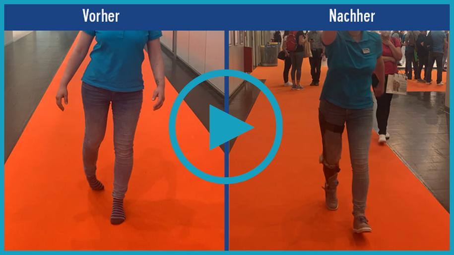 Patientenvideo Video einer Patientin mit Monoplegie. Vorher-nachher-Vergleich des Gangbilds ohne Versorgung Hilfsmittel und mit einer maßgefertigten Orthese KAFO mit NEURO SWING 2 Systemknöchelgelenk mit deutlich mehr Stabilität bei der Fortbewegung. KAFO ermöglicht sicheres Laufen.
