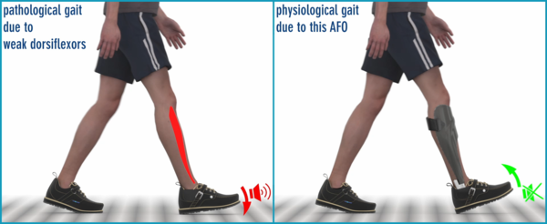 Excerpt from the video describing the action of the muscles that lift the foot to allow a free swing through without stumbling. The video describes the clapping noise of the forefoot and the compensatory effect, i.e. the effect on the gait pattern due to the drop foot drop foot with the compensation mechanisms hip elevation and circumduction and the risk of stumbling. The orthosis AFO with NEURO CLASSIC SPRING leads to a natural gait