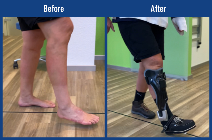 Patient video of a patient with polyneuropathy damaged peripheral nerves nervous system impaired stimulus transmission. Before-and-after comparison of the gait without treatment and with a custom-made AFO orthosis with NEURO HiSWING R plus system ankle joint. With device she can maintain her balance and no longer has to concentrate on walking.